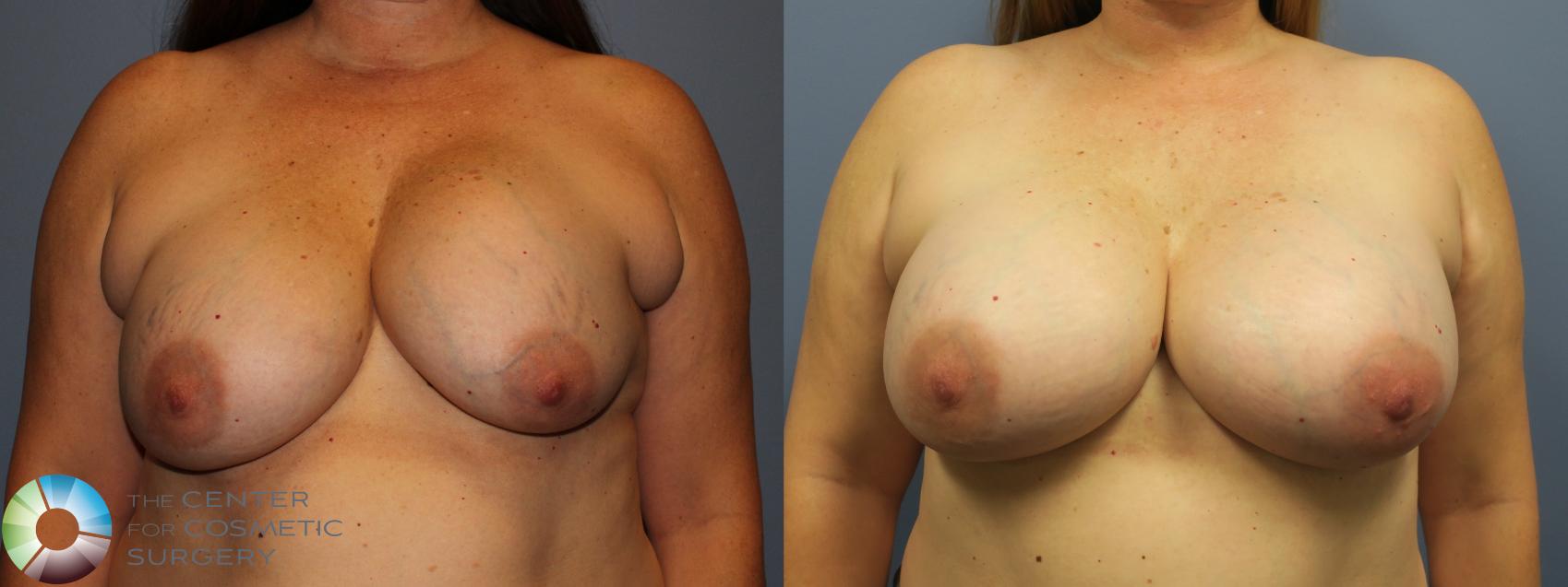 Before & After Breast Implant Revision Case 11743 Front in Denver and Colorado Springs, CO