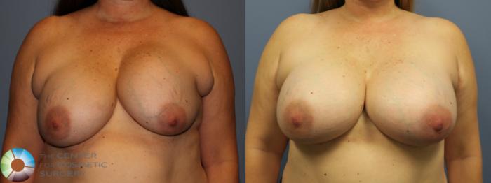 Before & After Breast Implant Revision Case 11743 Front View in Golden, CO