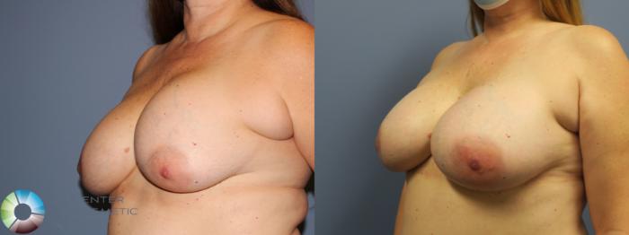 Best Denver Breast Implant Revision