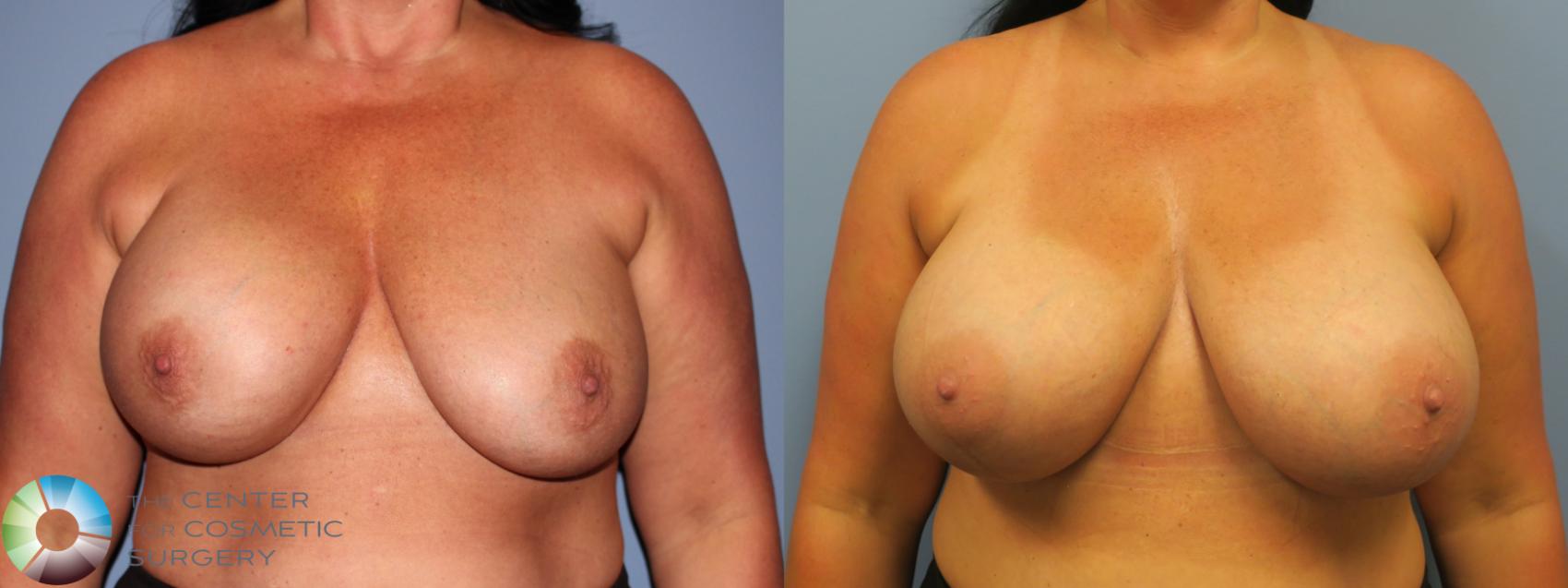 Before & After Breast Implant Revision Case 11744 Front in Denver and Colorado Springs, CO