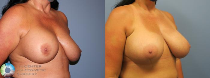 Before & After Breast Implant Revision Case 11744 Right Oblique in Denver and Colorado Springs, CO