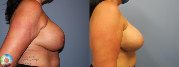Before & After Breast Implant Revision Case 11744 Right Side in Denver and Colorado Springs, CO