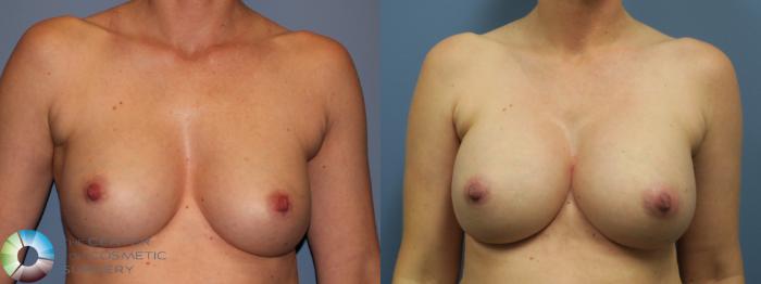 Before & After Breast Implant Revision Case 11747 Front in Denver and Colorado Springs, CO