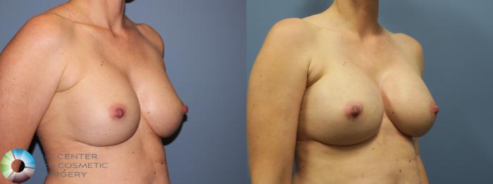 Before & After Breast Implant Revision Case 11747 Right Oblique in Denver and Colorado Springs, CO