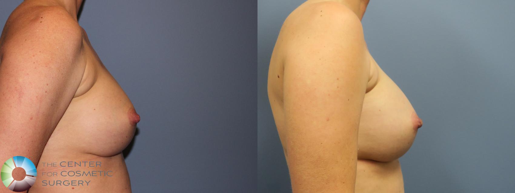 Best Denver Breast Implants Exchange Revision