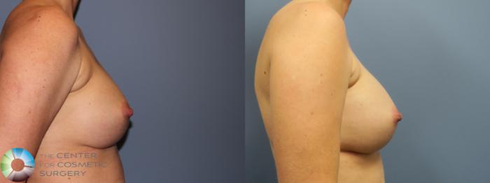 Before & After Breast Implant Revision Case 11747 Right Side in Denver and Colorado Springs, CO