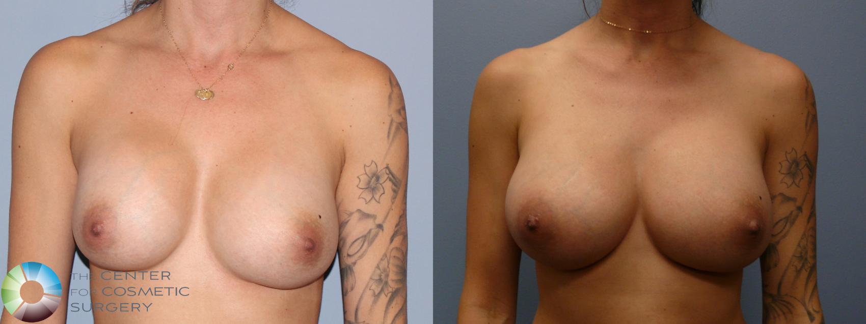 Before & After Breast Implant Revision Case 11765 Front in Denver and Colorado Springs, CO