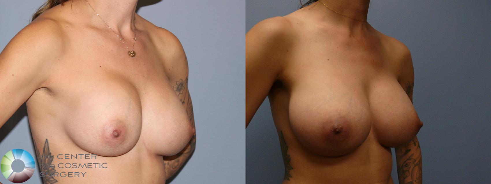 Before & After Breast Implant Revision Case 11765 Right Oblique in Denver and Colorado Springs, CO