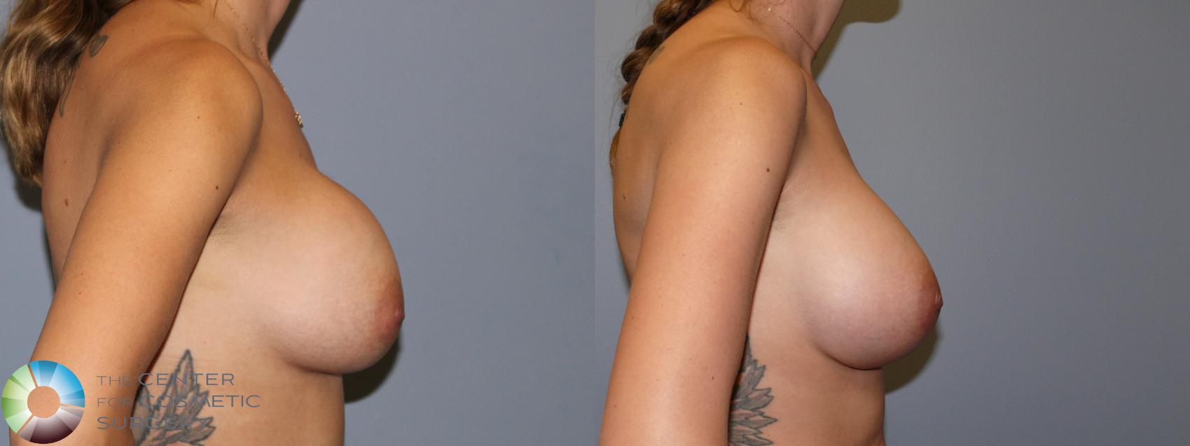 Before & After Breast Implant Revision Case 11765 Right Side in Denver and Colorado Springs, CO