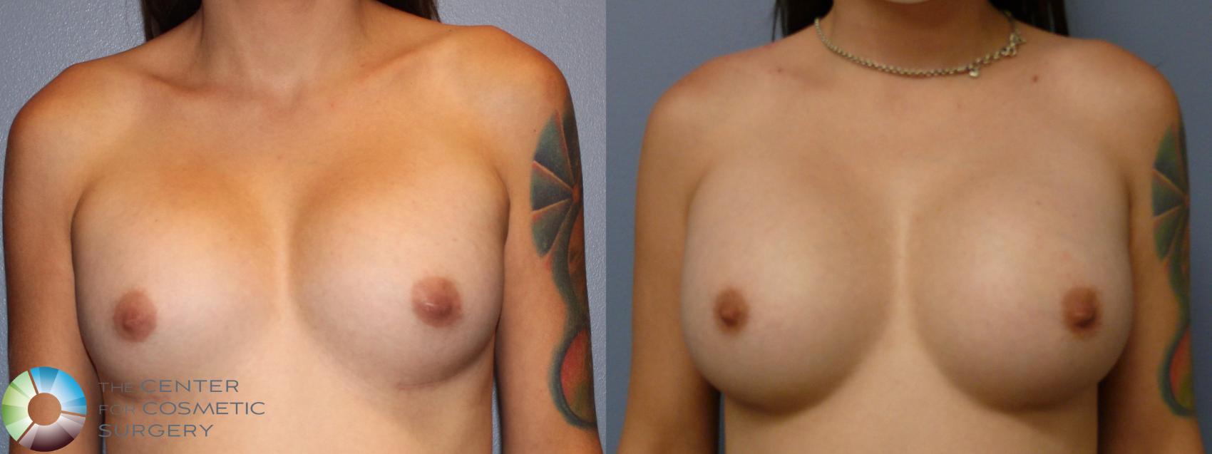 Before & After Breast Implant Revision Case 11766 Front in Denver and Colorado Springs, CO