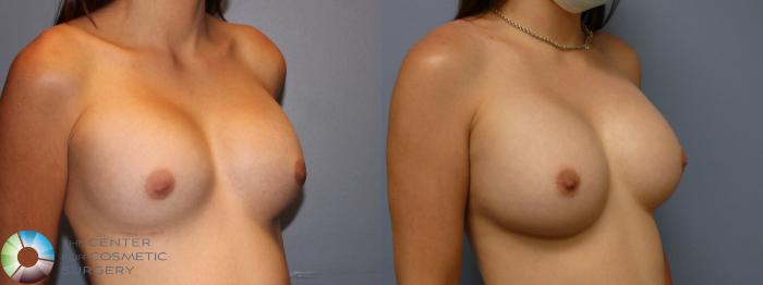 Before & After Breast Implant Revision Case 11766 Right Oblique in Denver and Colorado Springs, CO