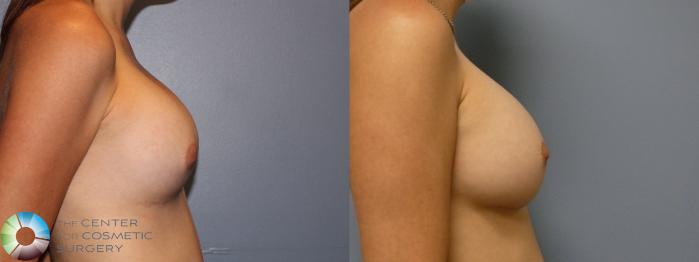 Before & After Breast Implant Revision Case 11766 Right Side in Denver and Colorado Springs, CO