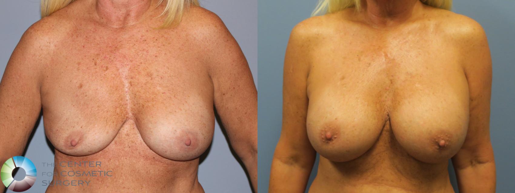 Before & After Breast Implant Revision Case 11799 Front View in Golden, CO
