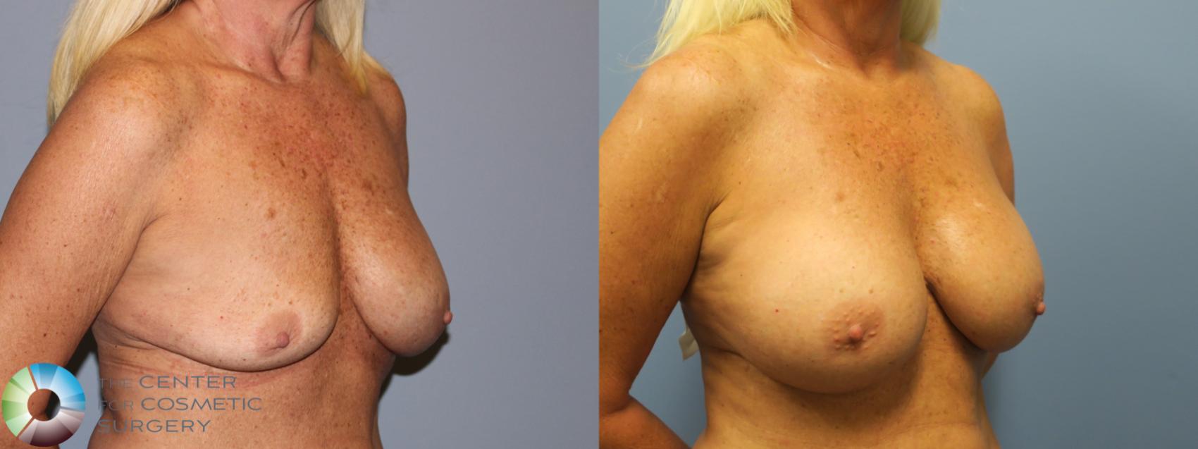 Best Denver Breast Implant Revision