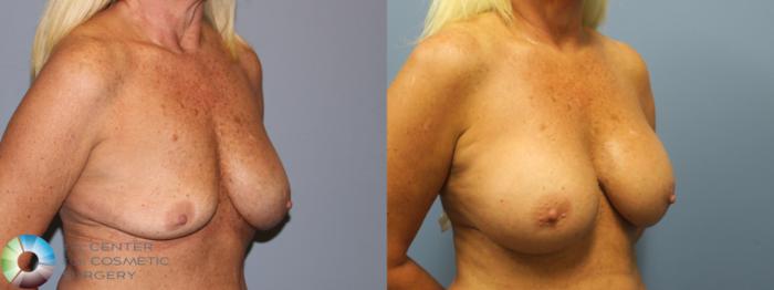 Before & After Breast Implant Revision Case 11799 Right Oblique View in Golden, CO