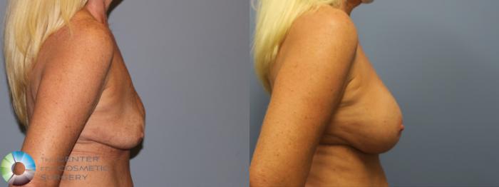 Before & After Breast Implant Revision Case 11799 Right Side View in Golden, CO