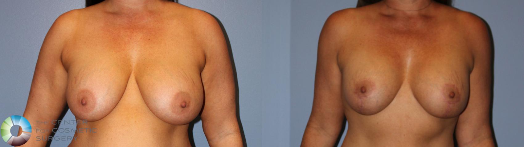 Before & After Breast Implant Revision Case 11879 Front in Denver and Colorado Springs, CO