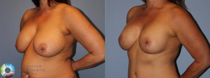 Before & After Breast Implant Revision Case 11879 Right Oblique in Denver and Colorado Springs, CO
