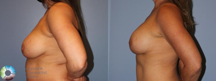 Before & After Breast Implant Revision Case 11879 Right Side in Denver and Colorado Springs, CO
