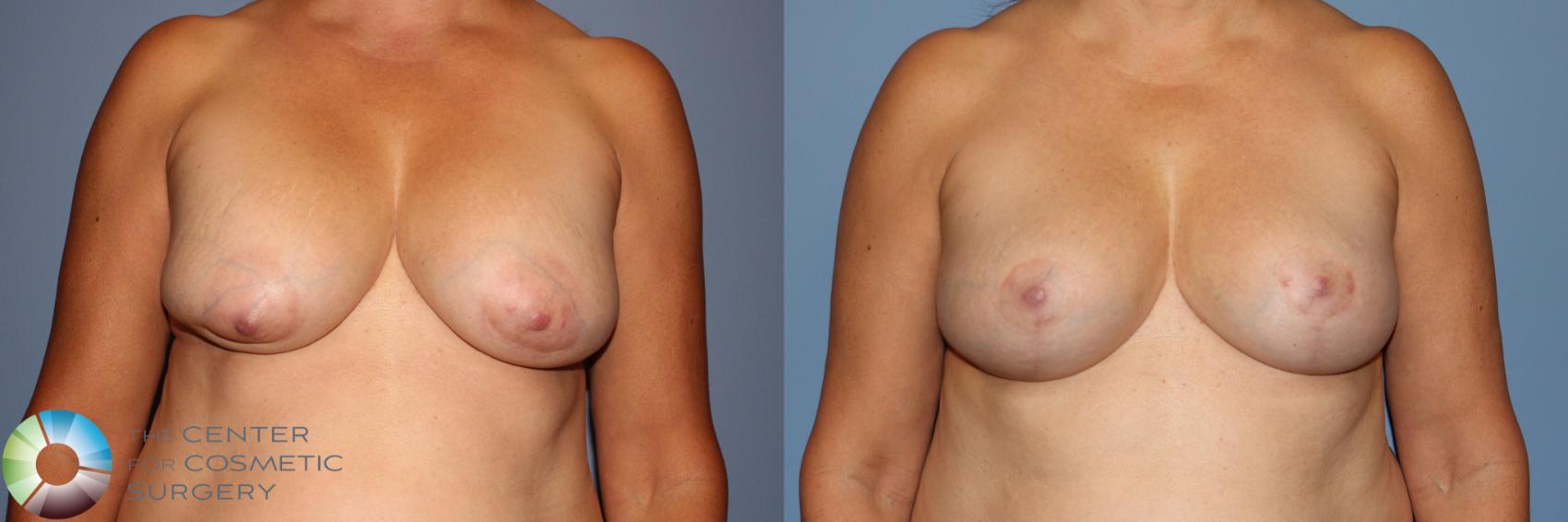 Before & After Breast Implant Revision Case 11881 Front View in Golden, CO