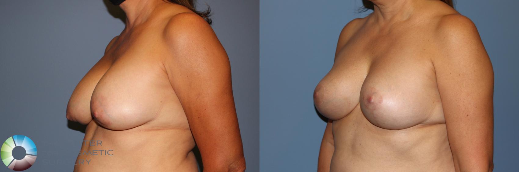 Before & After Breast Implant Revision Case 11881 Left Oblique in Denver and Colorado Springs, CO