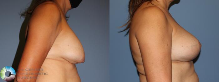 Before & After Breast Implant Revision Case 11881 Right Side View in Golden, CO