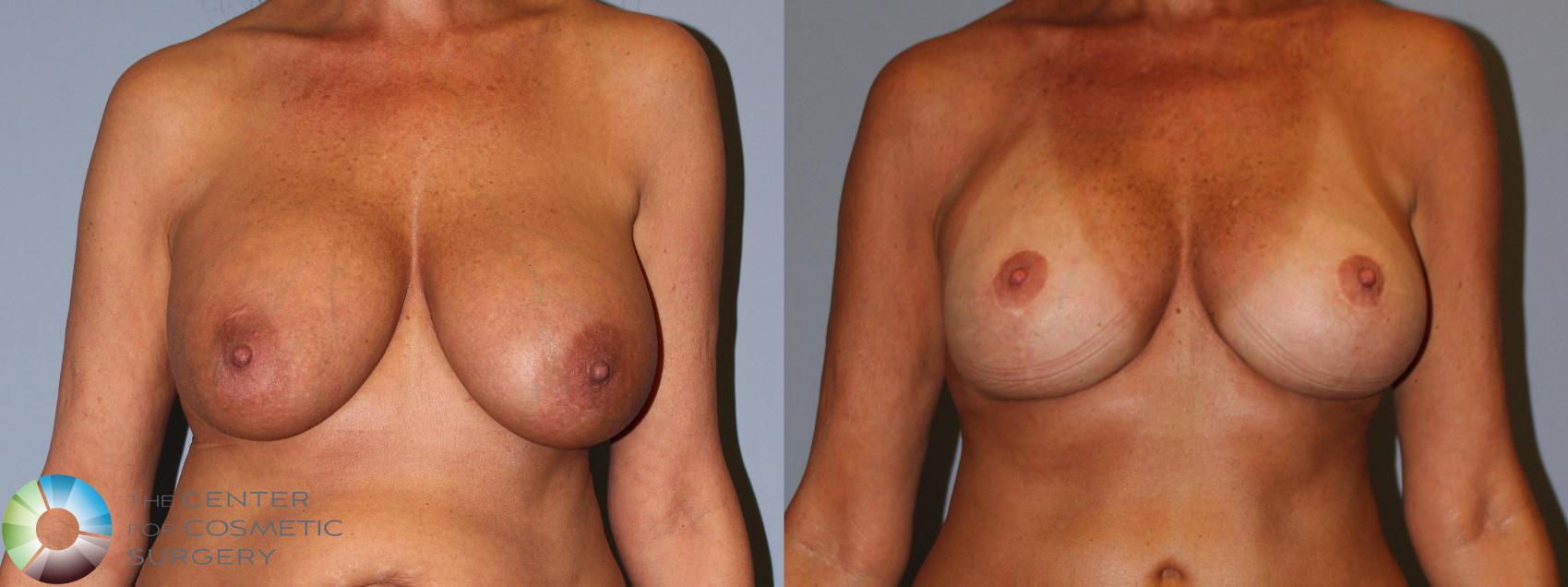 Before & After Breast Implant Revision Case 11899 Front View in Golden, CO