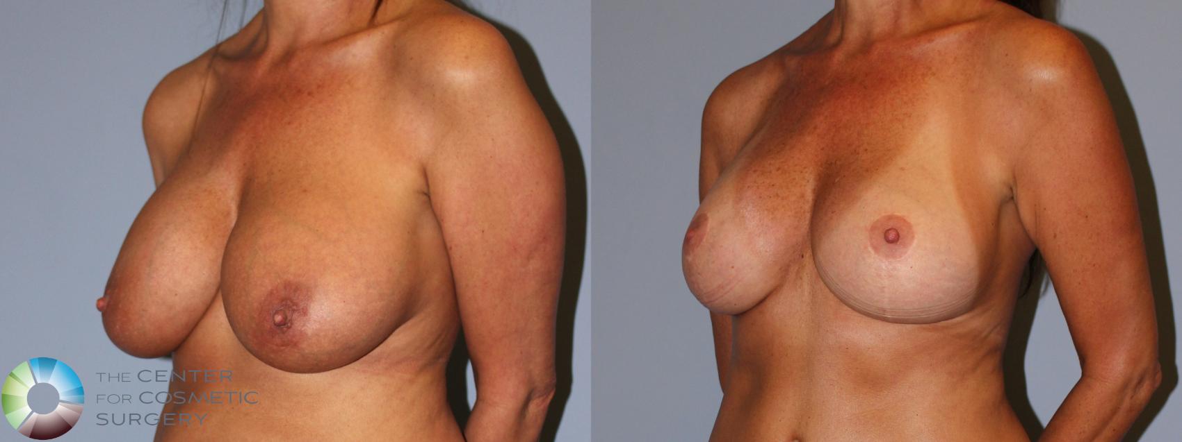 Before & After Breast Implant Revision Case 11899 Left Oblique in Denver and Colorado Springs, CO