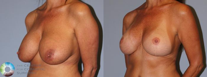 Before & After Breast Implant Revision Case 11899 Left Oblique View in Golden, CO