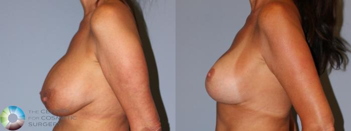 Before & After Breast Implant Revision Case 11899 Left Side View in Golden, CO