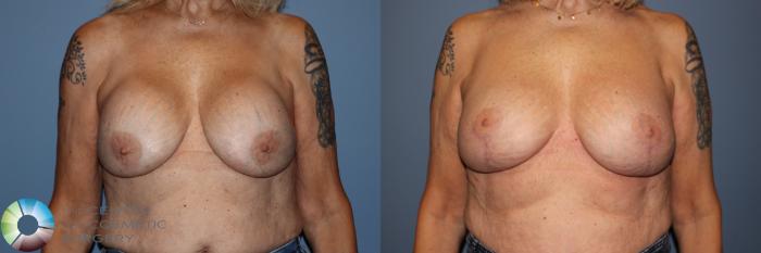 Before & After Breast Implant Revision Case 11910 Front View in Golden, CO
