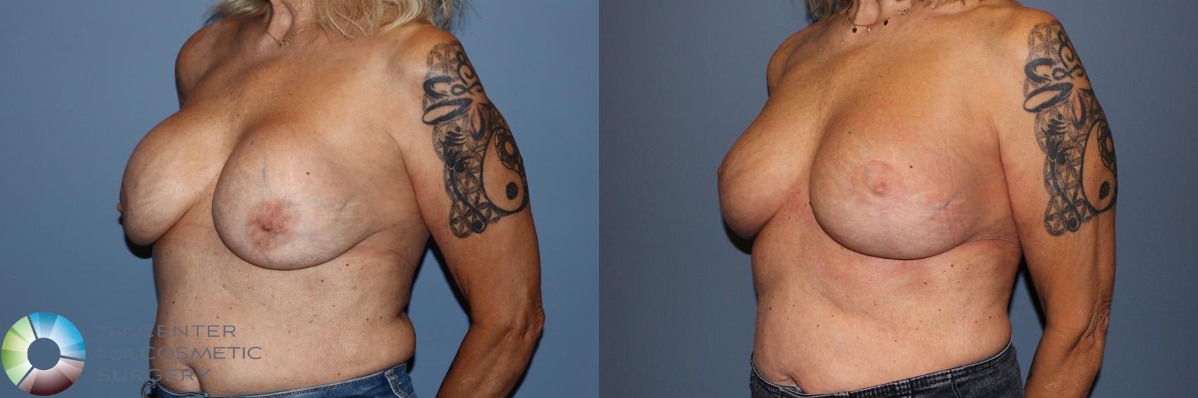 Before & After Breast Implant Revision Case 11910 Left Oblique in Denver and Colorado Springs, CO