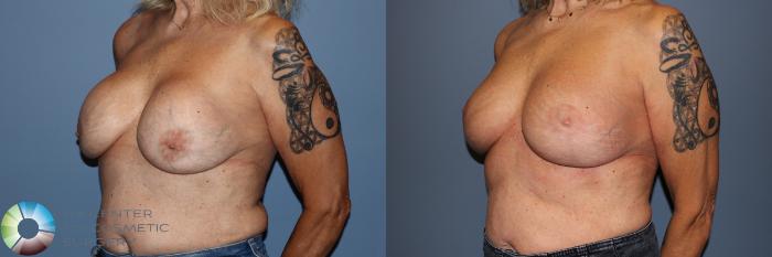 Before & After Breast Implant Revision Case 11910 Left Oblique View in Golden, CO