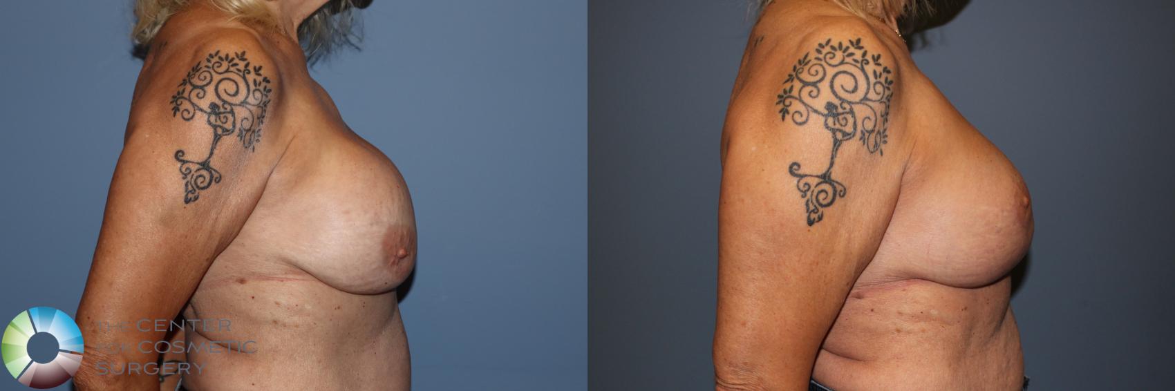 Before & After Breast Implant Revision Case 11910 Right Side in Denver and Colorado Springs, CO
