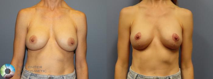 Before & After Breast Implant Revision Case 11922 Front in Denver and Colorado Springs, CO