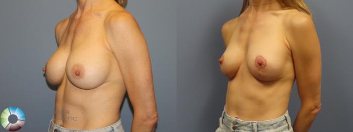 Before & After Breast Implant Revision Case 11922 Left Oblique in Denver and Colorado Springs, CO