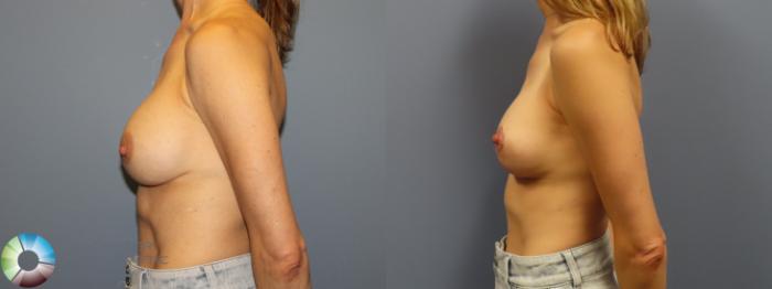 Before & After Breast Implant Revision Case 11922 Left Side in Denver and Colorado Springs, CO