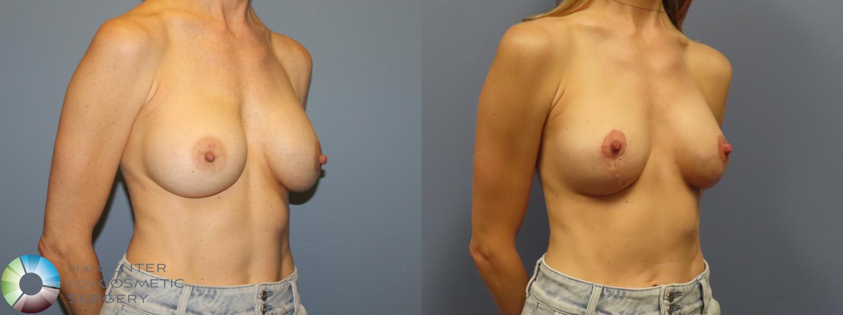 Before & After Breast Implant Revision Case 11922 Right Oblique in Denver and Colorado Springs, CO