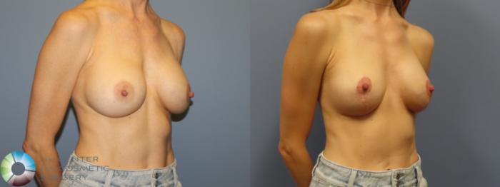 Before & After Breast Lift Case 11922 Right Oblique in Denver and Colorado Springs, CO