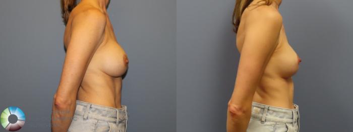 Before & After Breast Implant Revision Case 11922 Right Side in Denver and Colorado Springs, CO