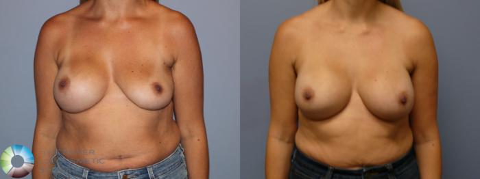 Before & After Breast Implant Revision Case 11961 Front in Denver and Colorado Springs, CO