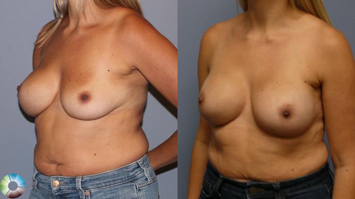 Before & After Breast Implant Revision Case 11961 Left Oblique in Denver and Colorado Springs, CO