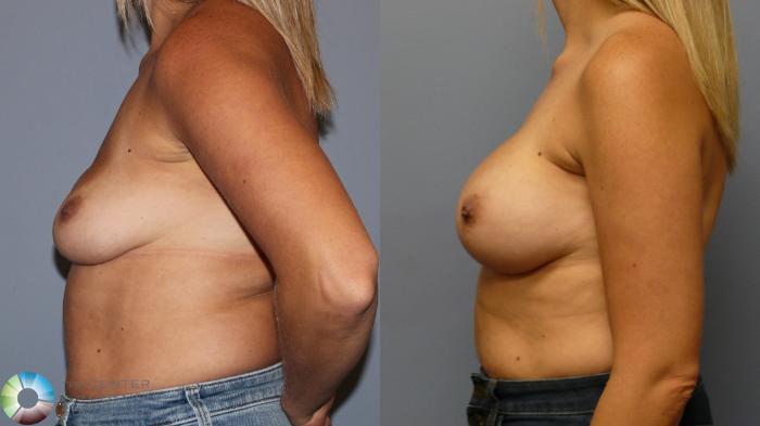 Before & After Breast Implant Revision Case 11961 Left Side in Denver and Colorado Springs, CO