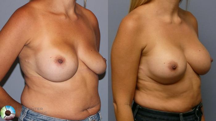 Before & After Breast Implant Revision Case 11961 Right Oblique in Denver and Colorado Springs, CO