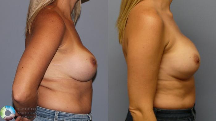 Before & After Breast Implant Revision Case 11961 Right Side in Denver and Colorado Springs, CO