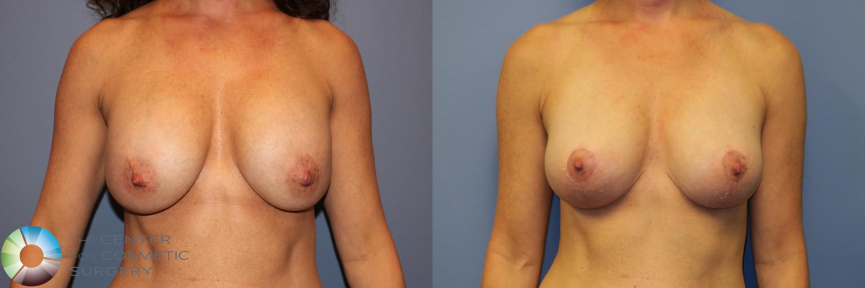 Before & After Breast Implant Revision Case 11967 Front in Denver and Colorado Springs, CO