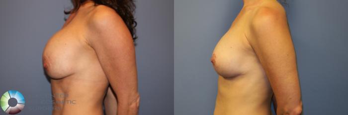 Before & After Breast Implant Revision Case 11967 Left Side in Denver and Colorado Springs, CO