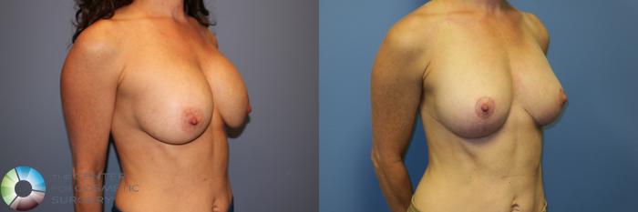 Before & After Breast Implant Revision Case 11967 Right Oblique in Denver and Colorado Springs, CO