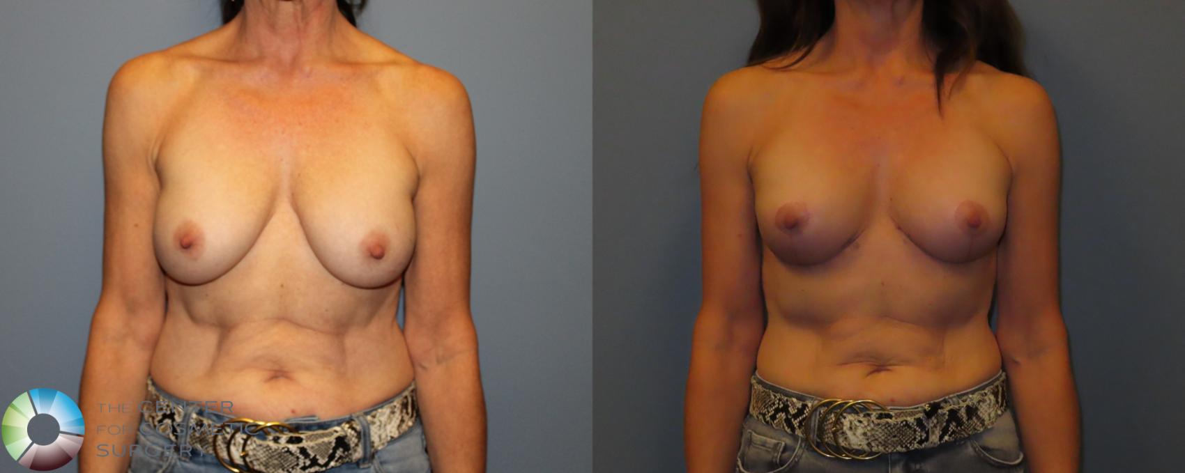 Before & After Breast Lift Case 12014 Front in Denver and Colorado Springs, CO