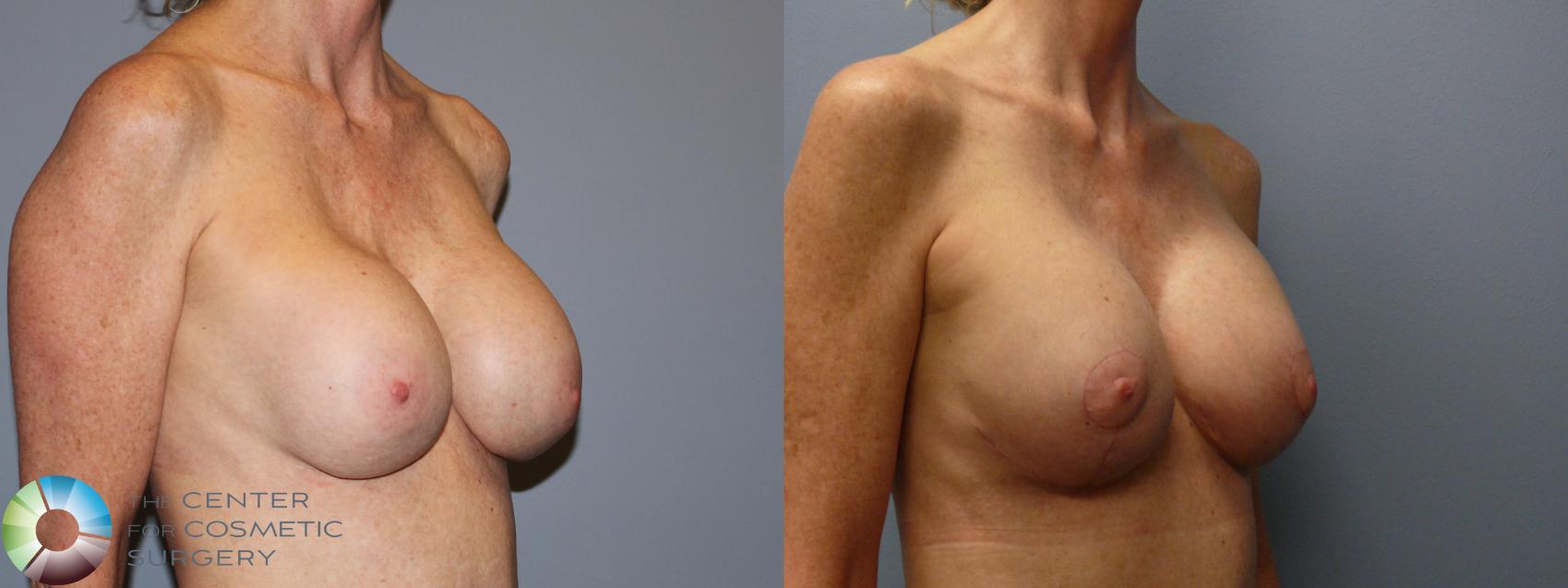 Before & After Breast Implant Revision Case 12045 Right Oblique in Denver and Colorado Springs, CO